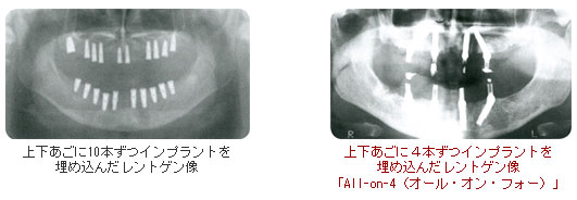 All-on-4(オール・オン・フォー)レントゲン写真