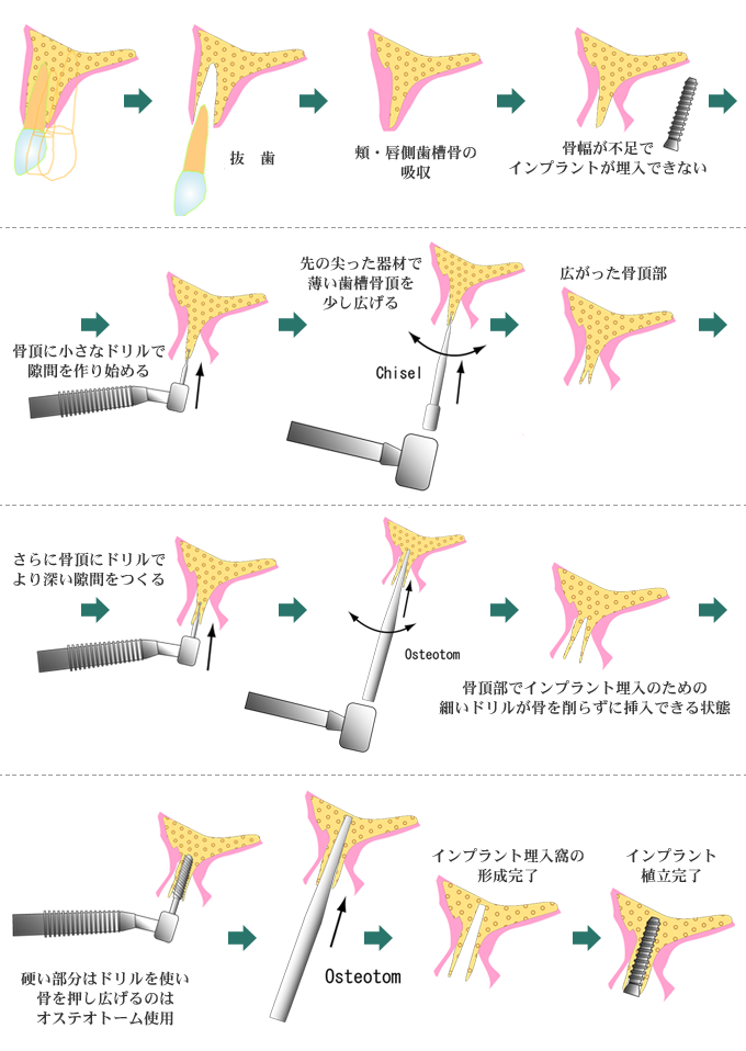 ソケットリフト法