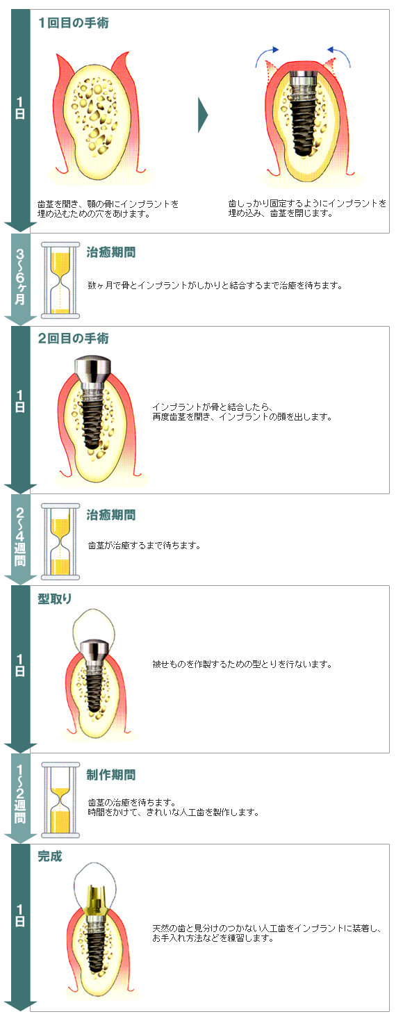 インプラント治療2回法の治療の流れ図解