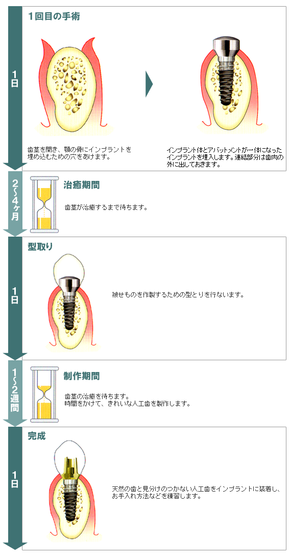 インプラント治療1回法の治療の流れ図解