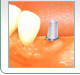 一般的なインプラント治療