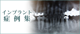 インプラント症例集